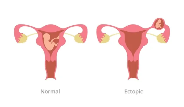 Ectopic Pregnancy Problem Comparison